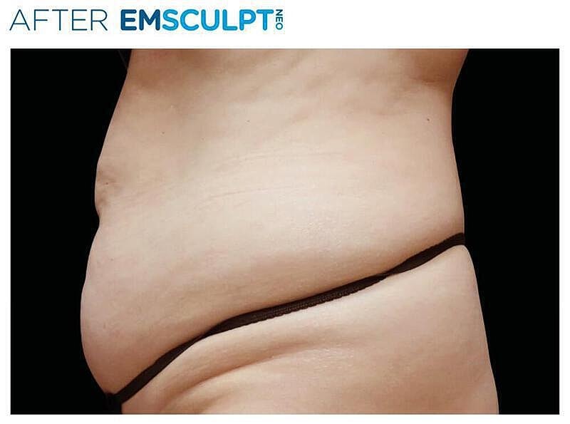 Emsculpt Abdomen Before & After