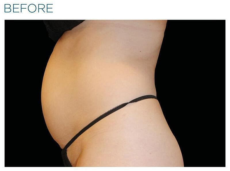 Emsculpt Abdomen Before & After