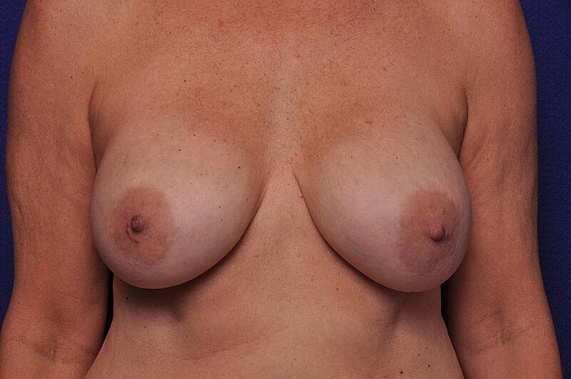 Breast Lift Before & After