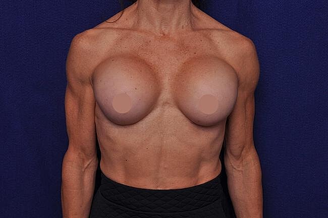 Athletic Breast Augmentation Revision Before & After