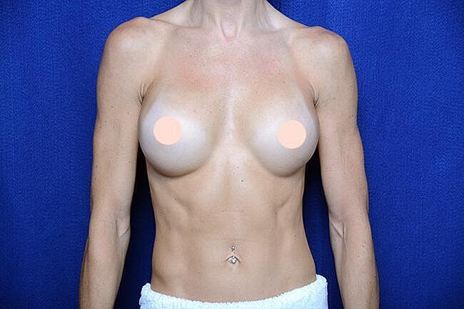 Athletic Breast Augmentation Revision Before & After