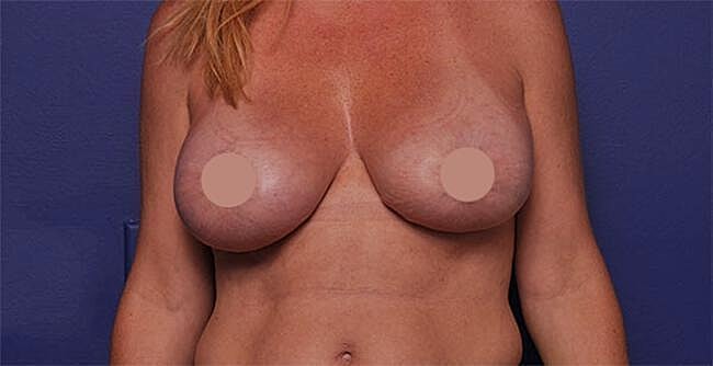Breast Augmentation Before & After