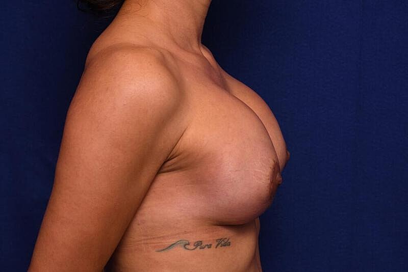 Breast Augmentation Before & After
