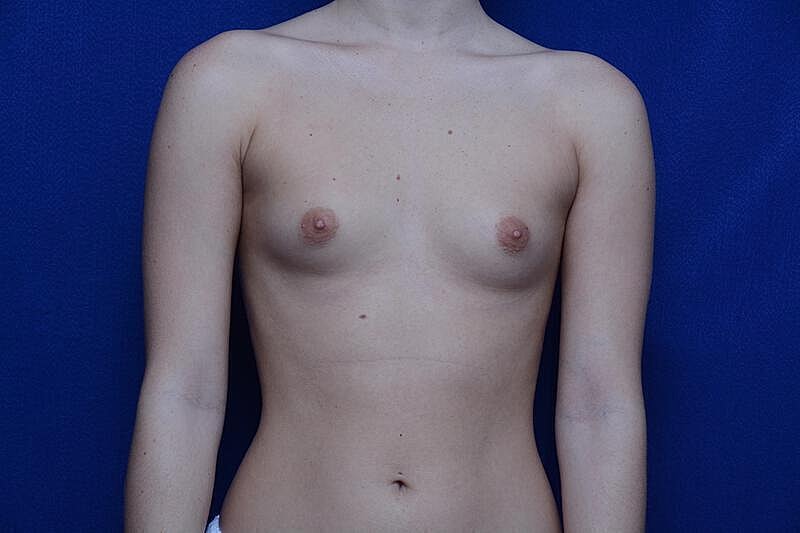 Breast Augmentation Before & After