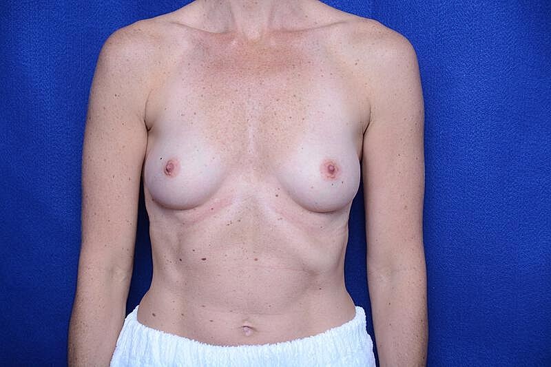 Breast Augmentation Before & After