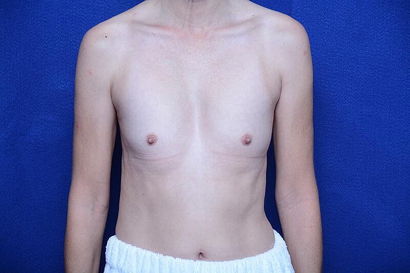 Breast Augmentation Before & After