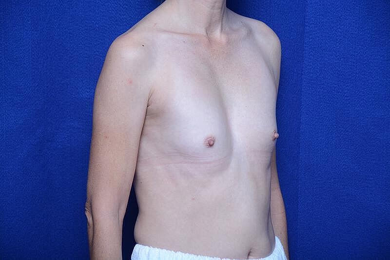 Breast Augmentation Before & After