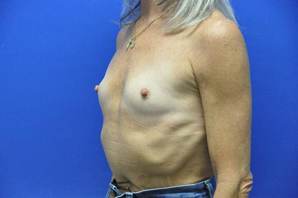 Breast Augmentation Before & After