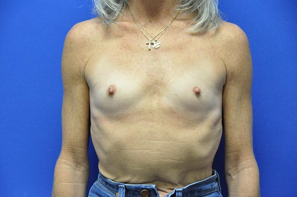 Breast Augmentation Before & After