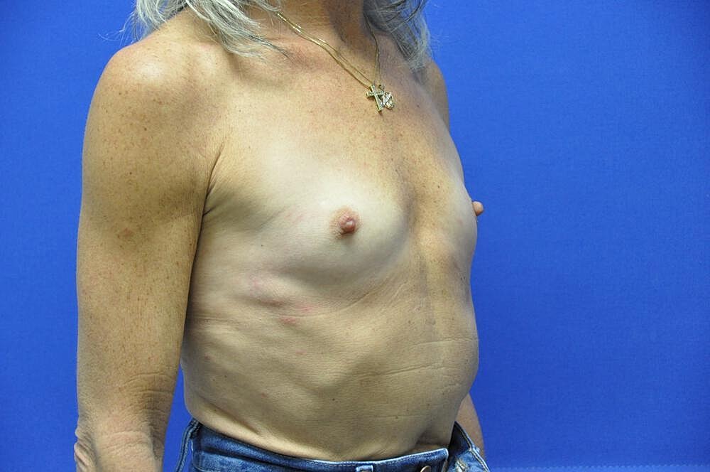 Breast Augmentation Before & After