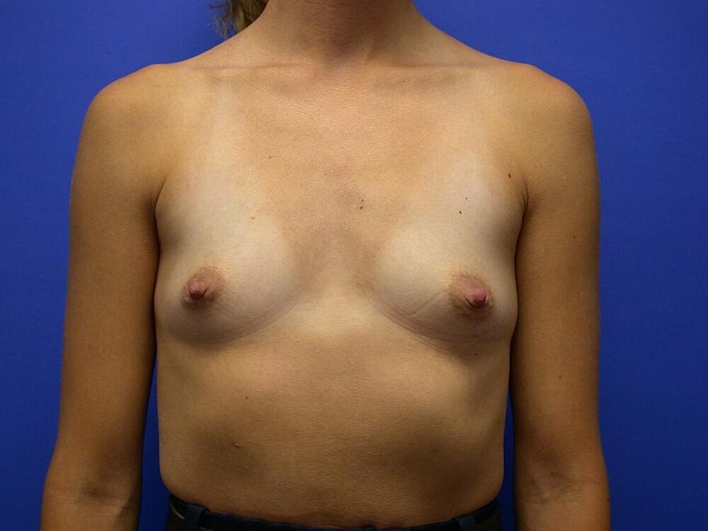 Breast Augmentation Before & After