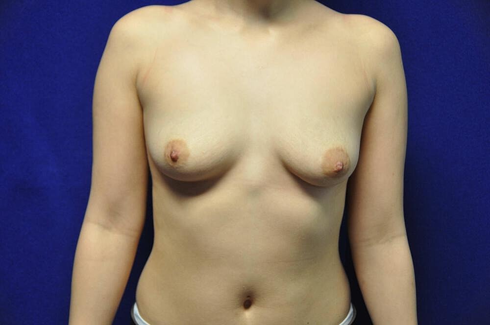 Breast Augmentation Before & After