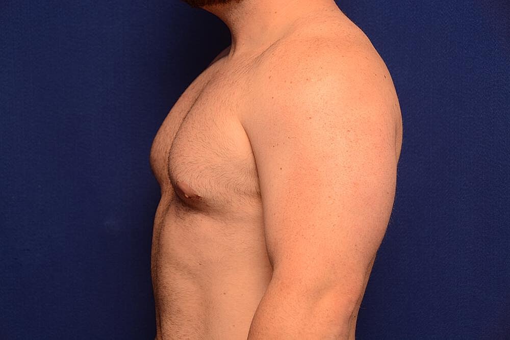 Gynecomastia Surgery Before & After