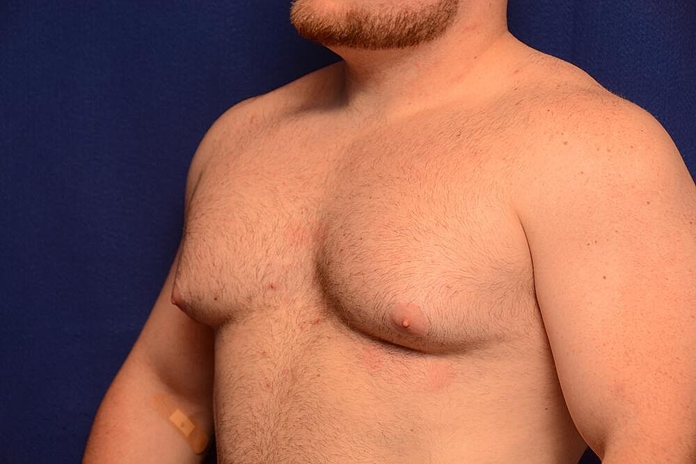 Gynecomastia Surgery Before & After