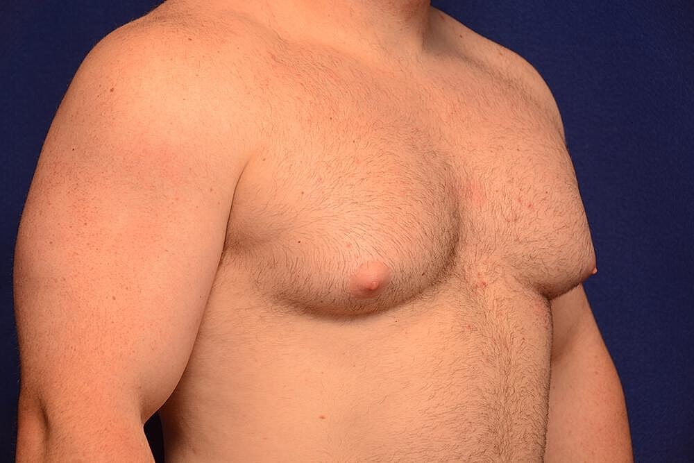 Gynecomastia Surgery Before & After