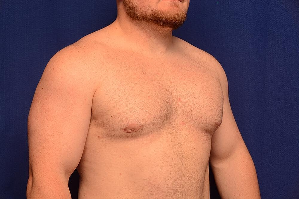 Gynecomastia Surgery Before & After