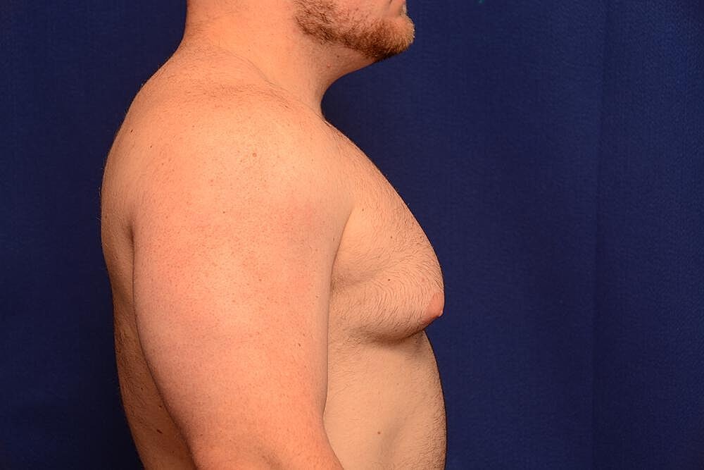 Gynecomastia Surgery Before & After