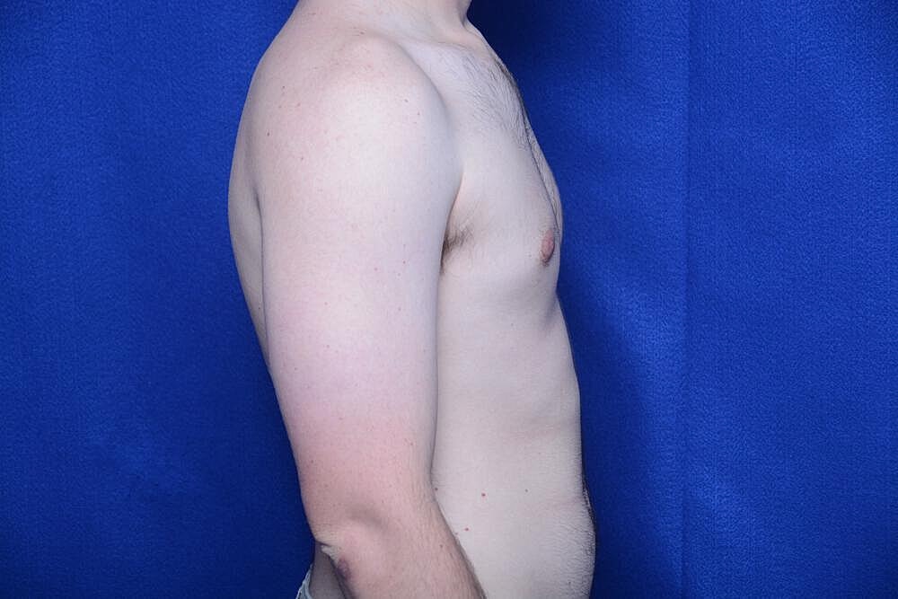 Gynecomastia Surgery Before & After