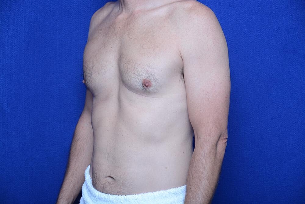 Gynecomastia Surgery Before & After