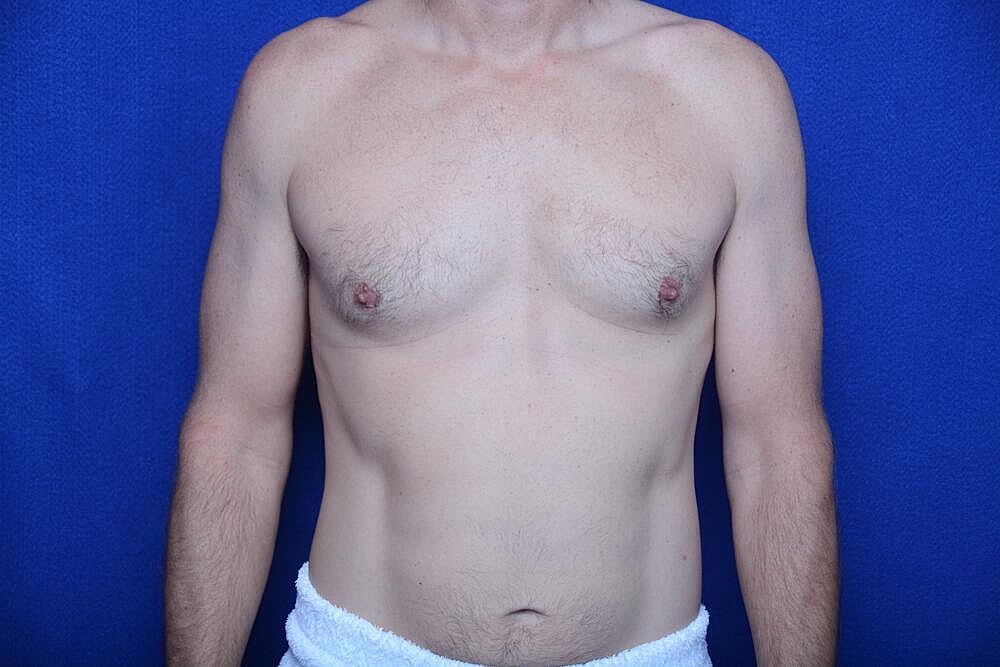 Gynecomastia Surgery Before & After