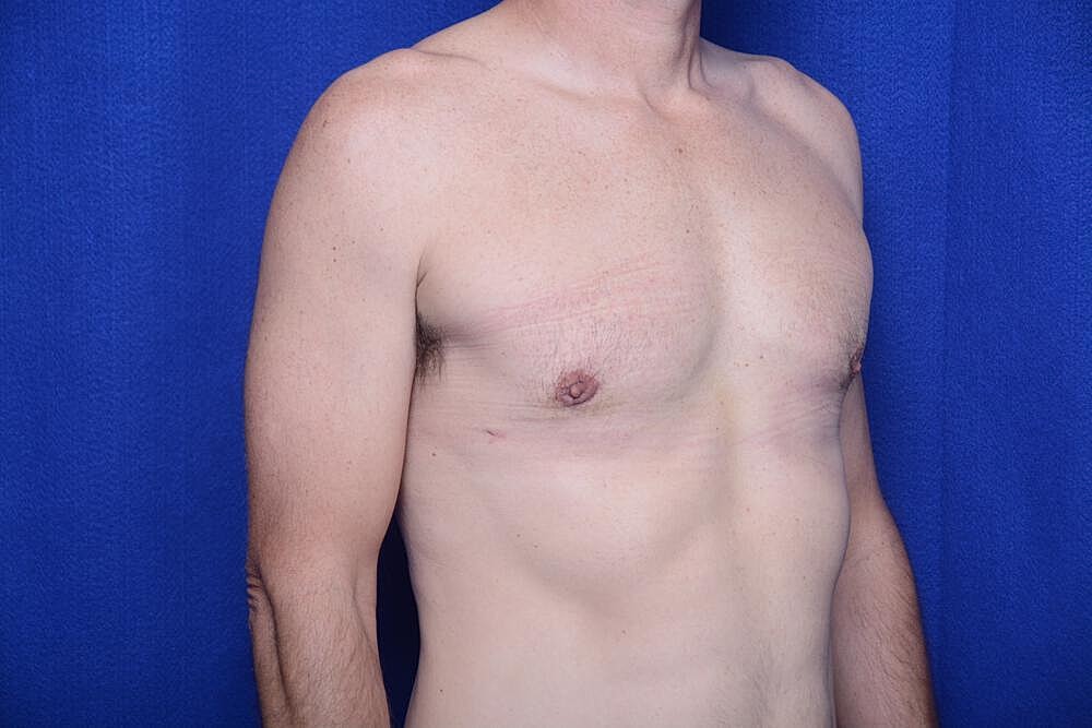 Gynecomastia Surgery Before & After