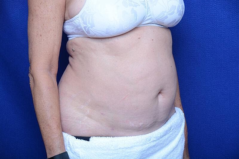 Liposuction Before & After
