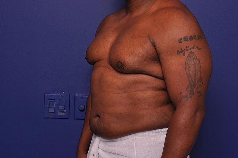 Liposuction Before & After