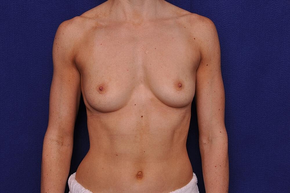 Athletic Breast Augmentation Before & After