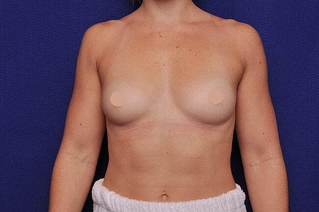 Athletic Breast Augmentation Before & After