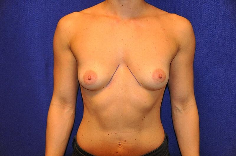 Athletic Breast Augmentation Before & After