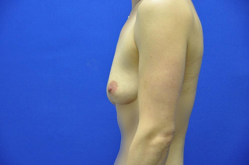 Athletic Breast Augmentation Before & After