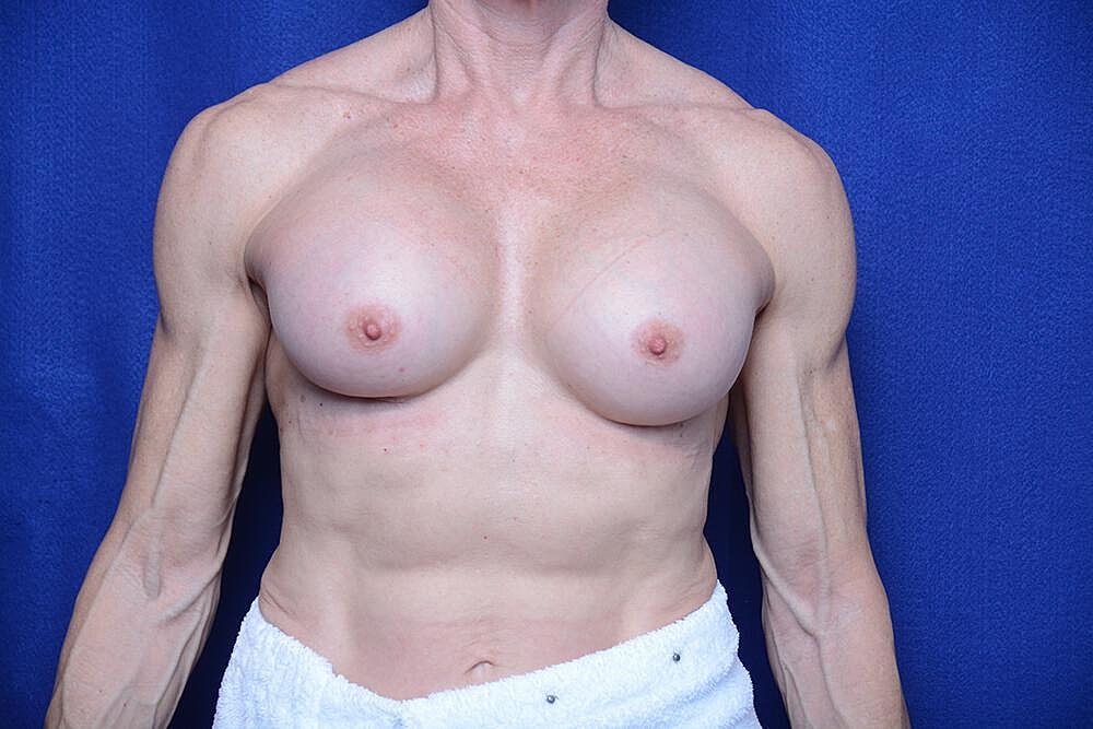 Athletic Breast Augmentation Before & After