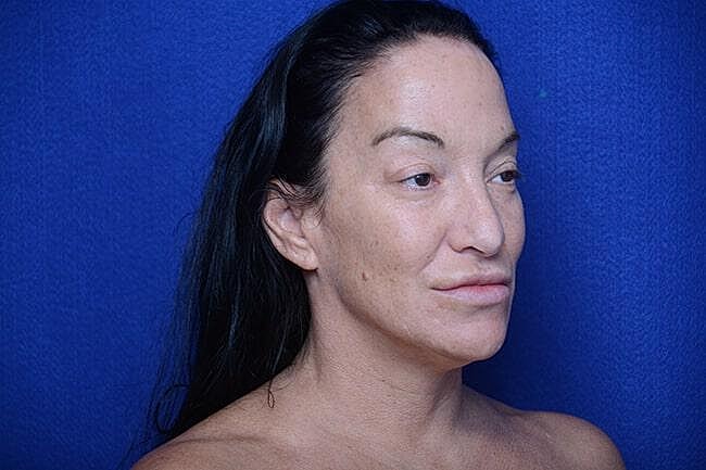 Fat Transfer To Lips Before & After