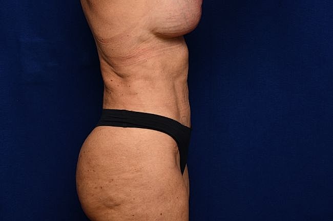 Semaglutide Before & After