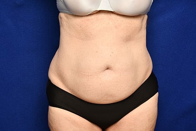 Semaglutide Before & After