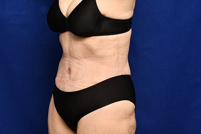 Semaglutide Before & After