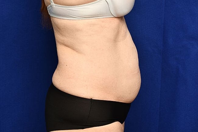 Semaglutide Before & After