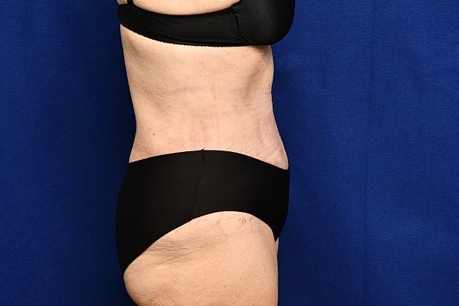 Semaglutide Before & After