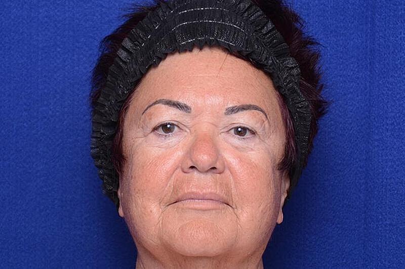 Upper Blepharoplasty Before & After