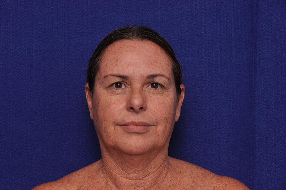 Upper Blepharoplasty Before & After
