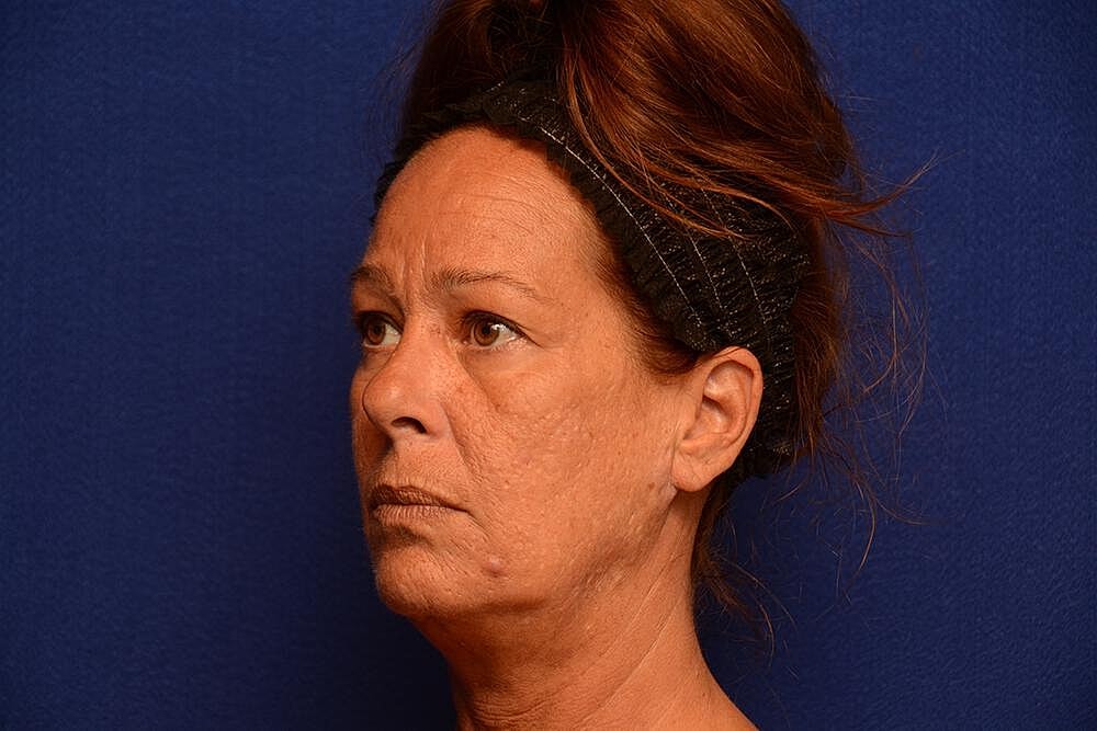 Upper Blepharoplasty Before & After