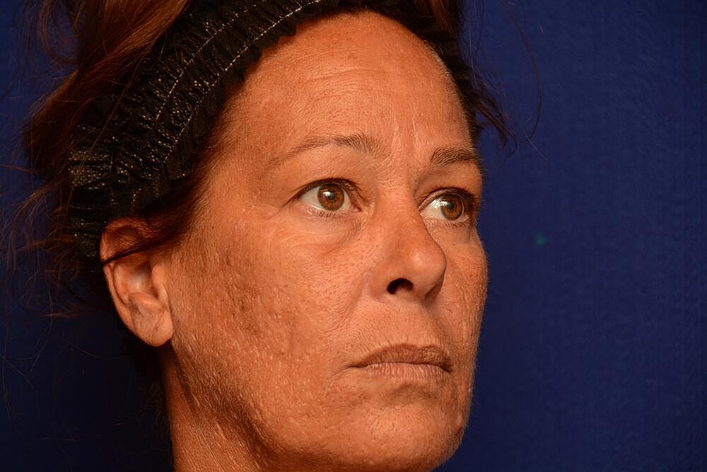 Upper Blepharoplasty Before & After