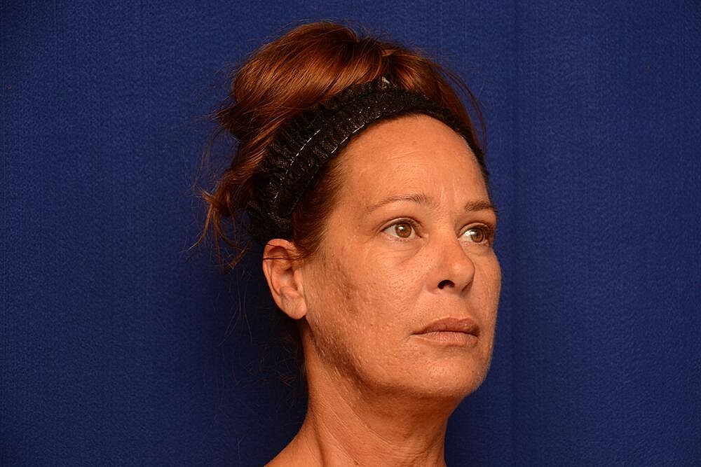 Upper Blepharoplasty Before & After