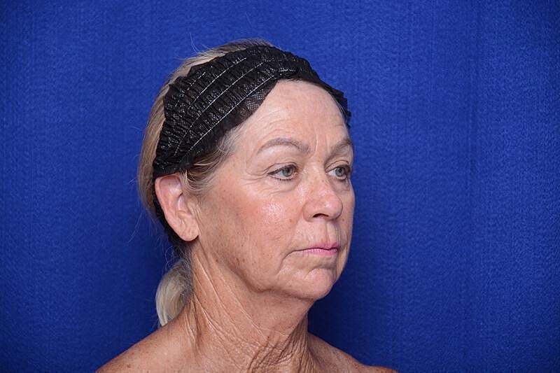 Upper Blepharoplasty Before & After