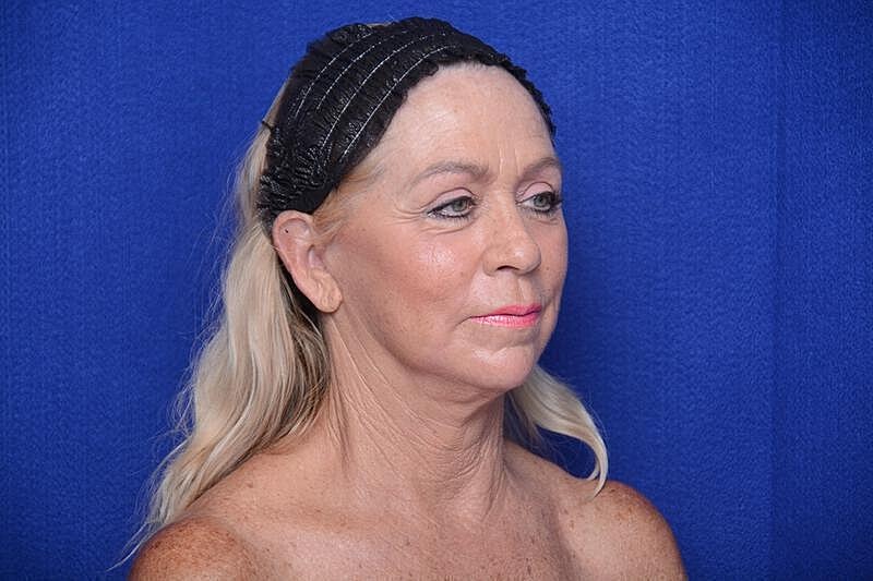 Upper Blepharoplasty Before & After