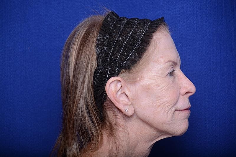 Upper Blepharoplasty Before & After