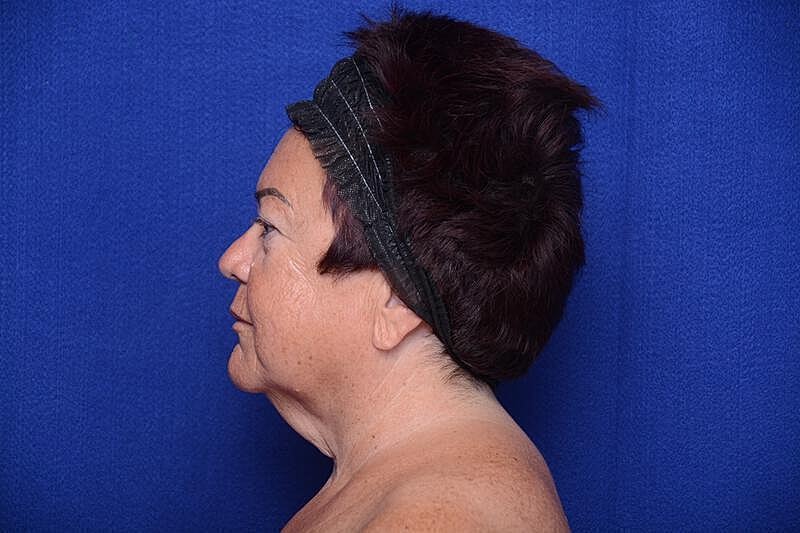 Upper Blepharoplasty Before & After