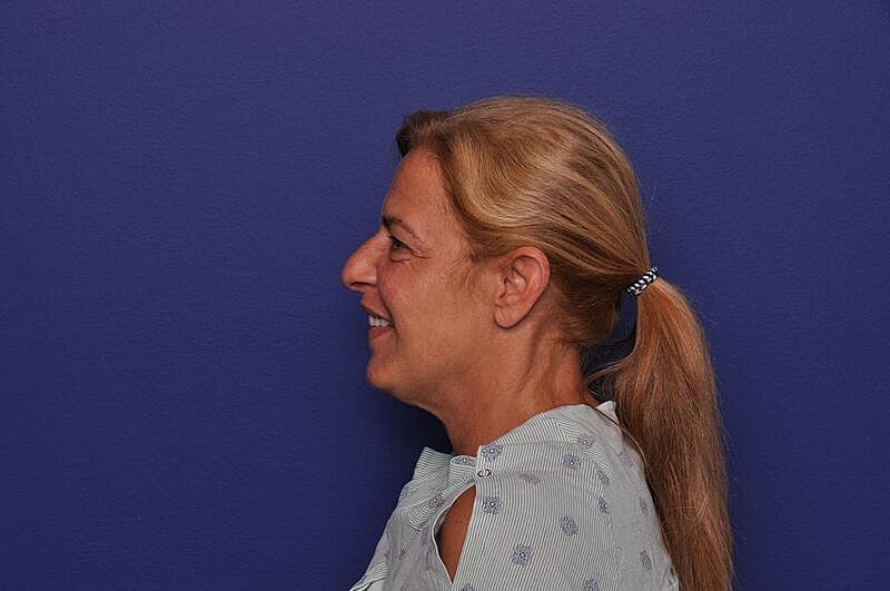 Upper Blepharoplasty Before & After