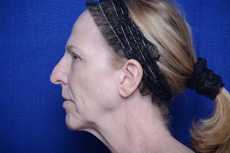 Upper Blepharoplasty Before & After