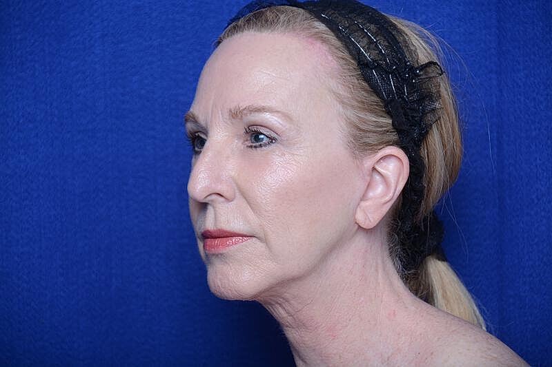 Upper Blepharoplasty Before & After